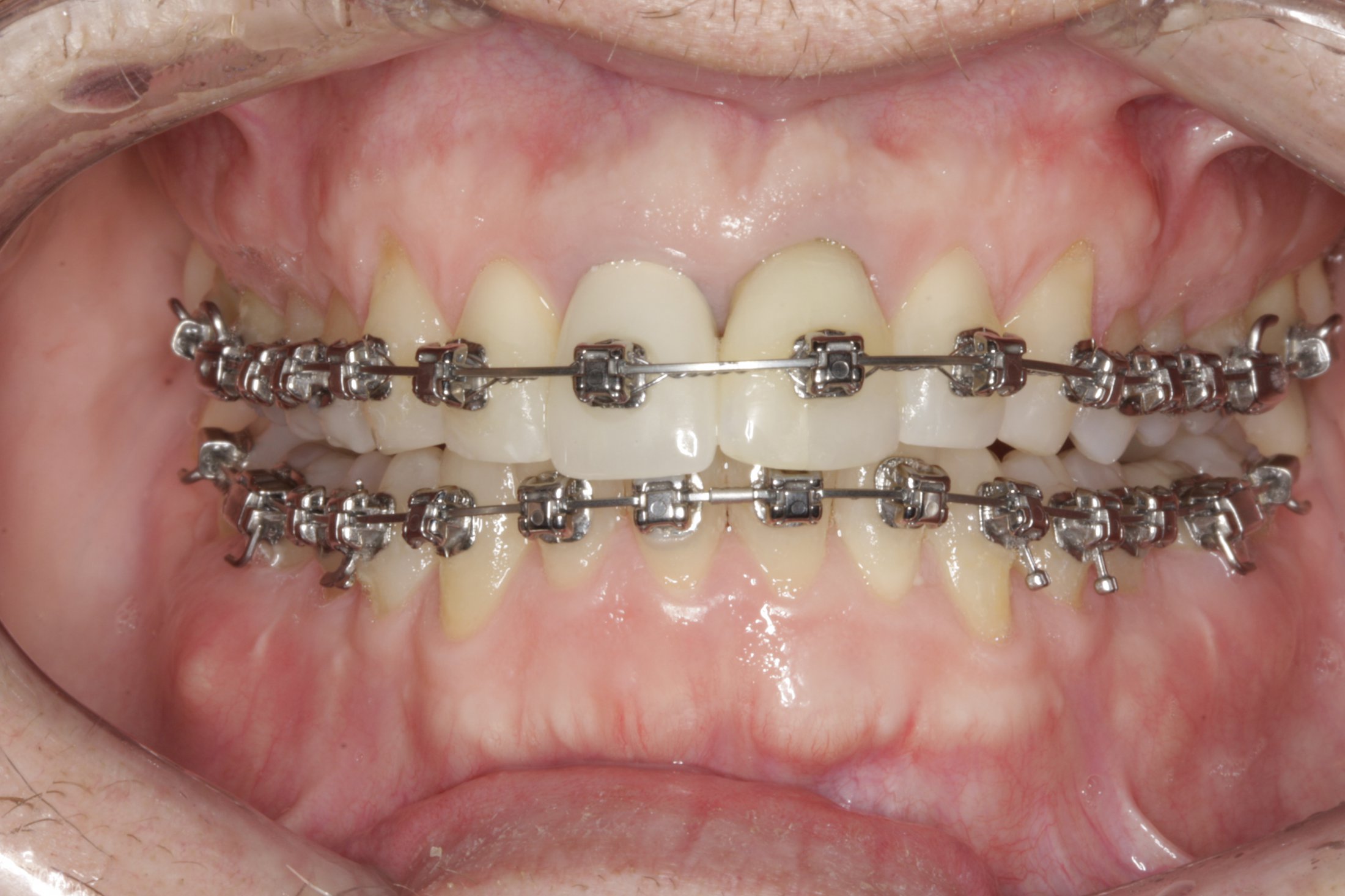 Periodontally accelerated osteogenic case study