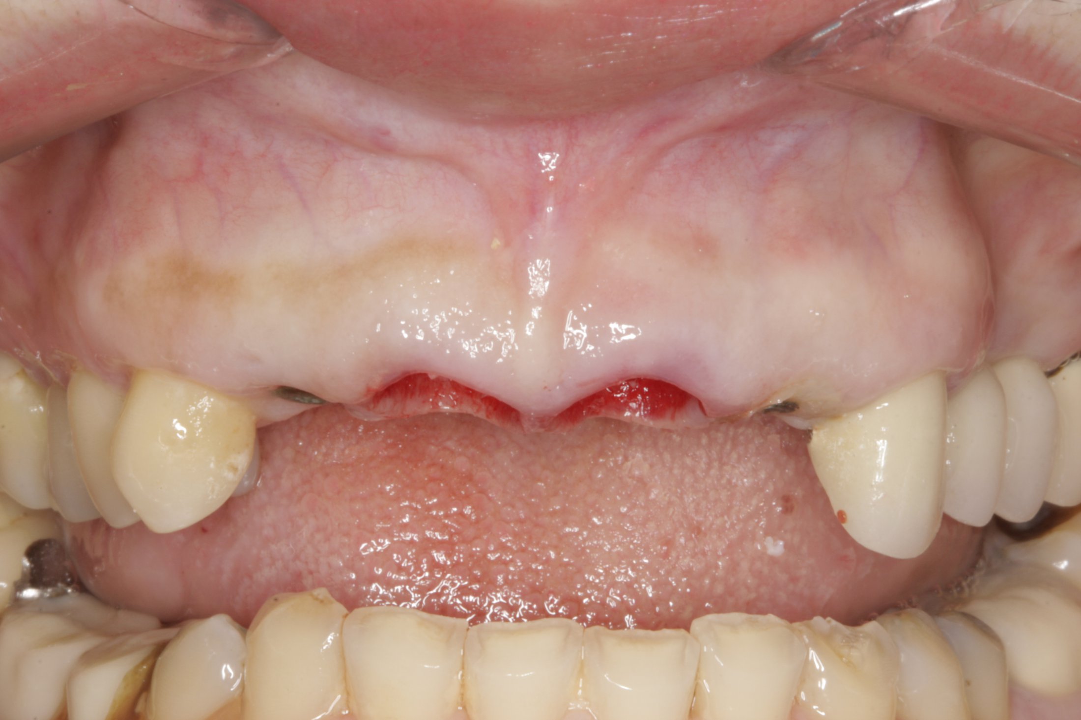 Dental Implants case study