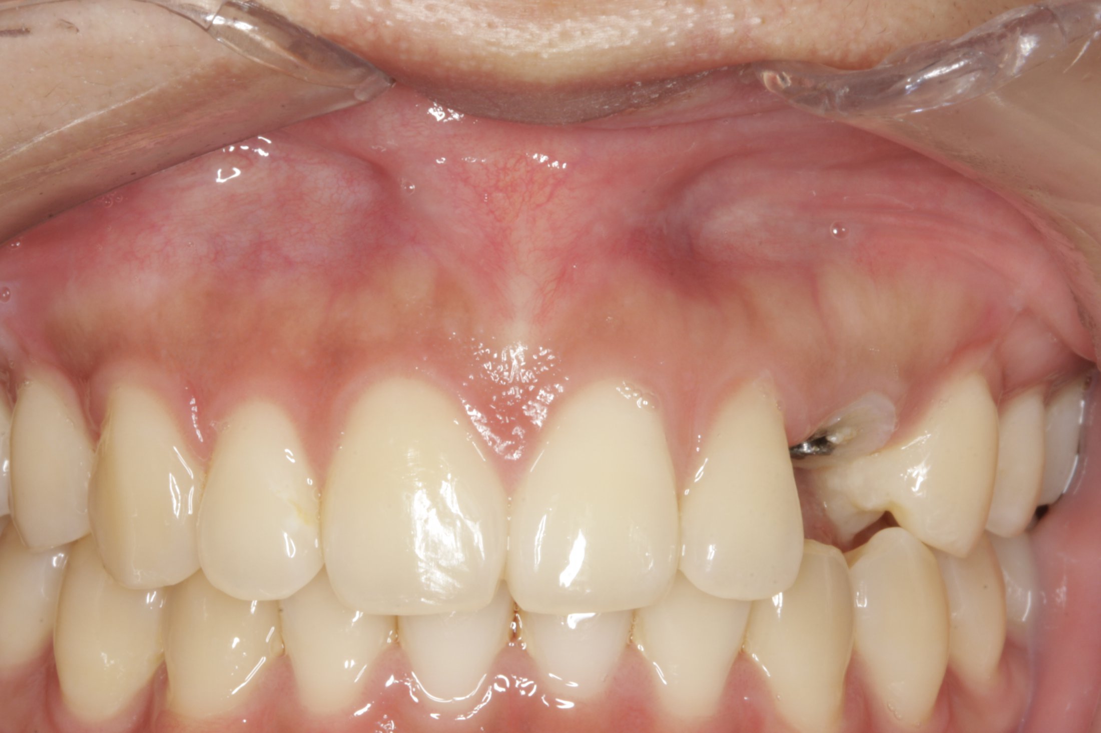 Dental Implants case study