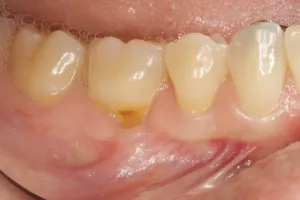 Connective Tissue Graft case study