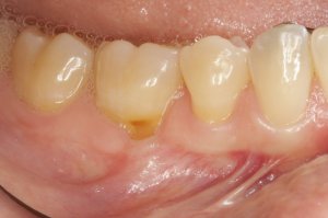 Connective Tissue Graft case study