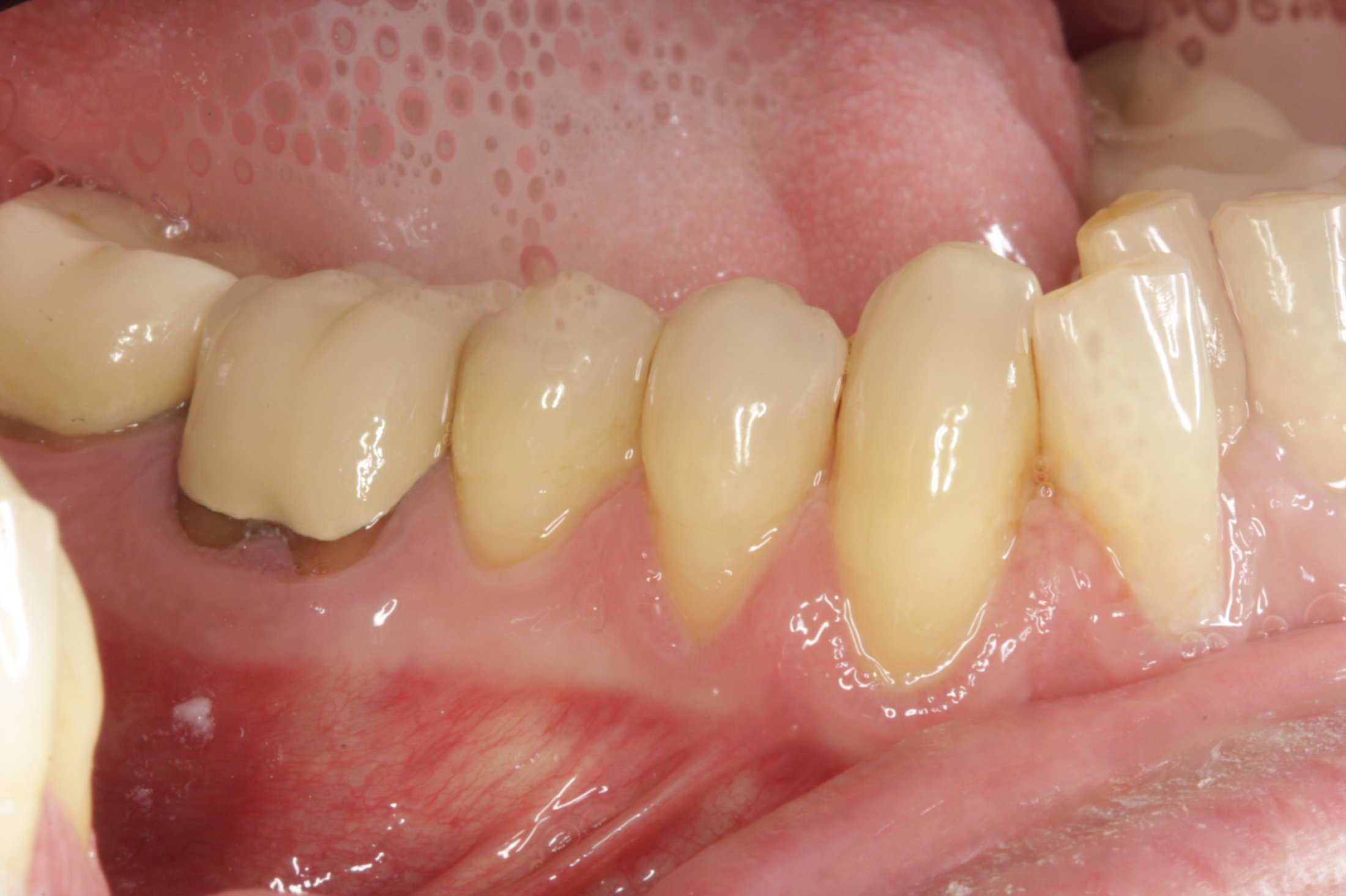 Allograft case study