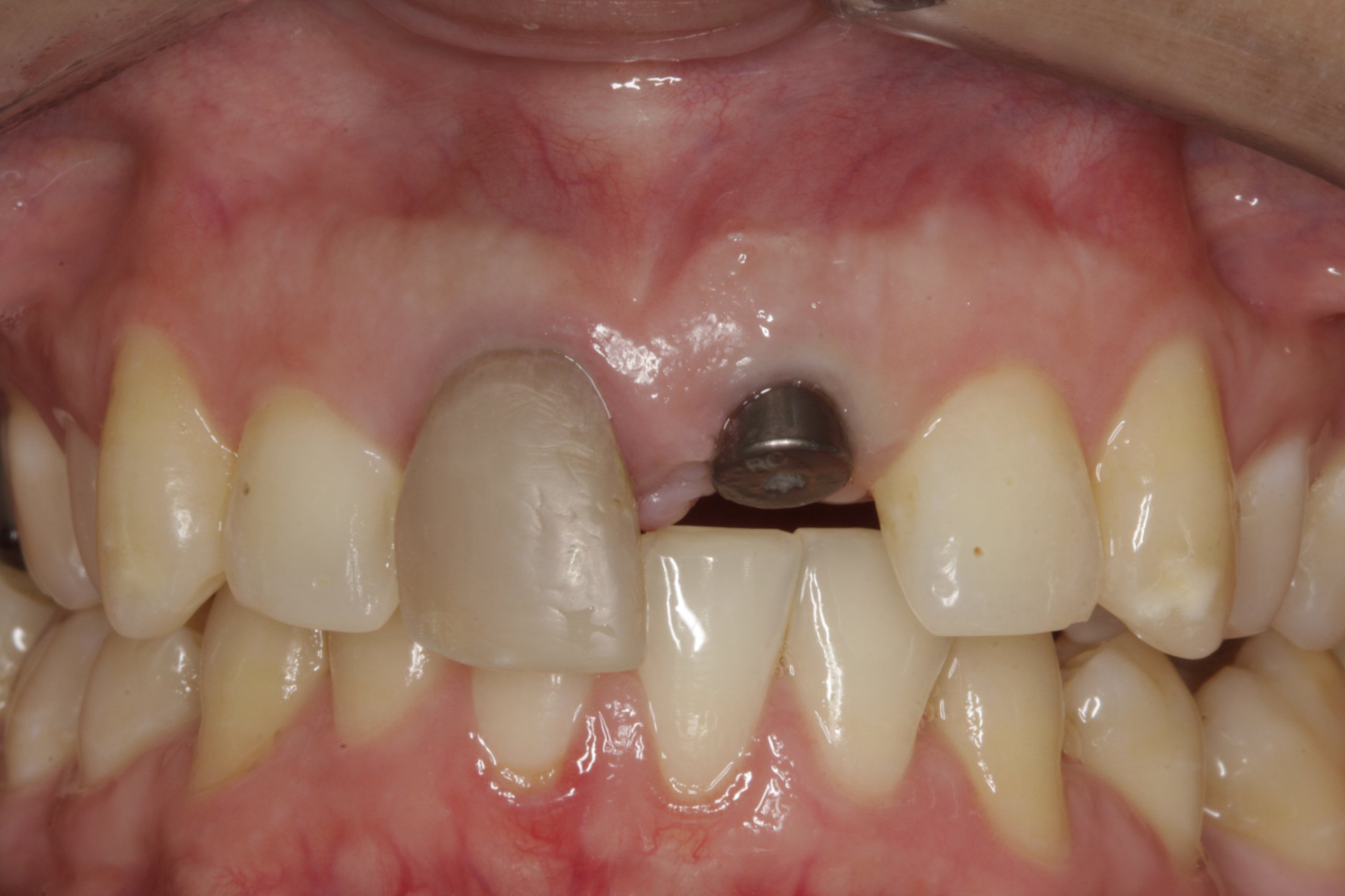 Dental Implants case study