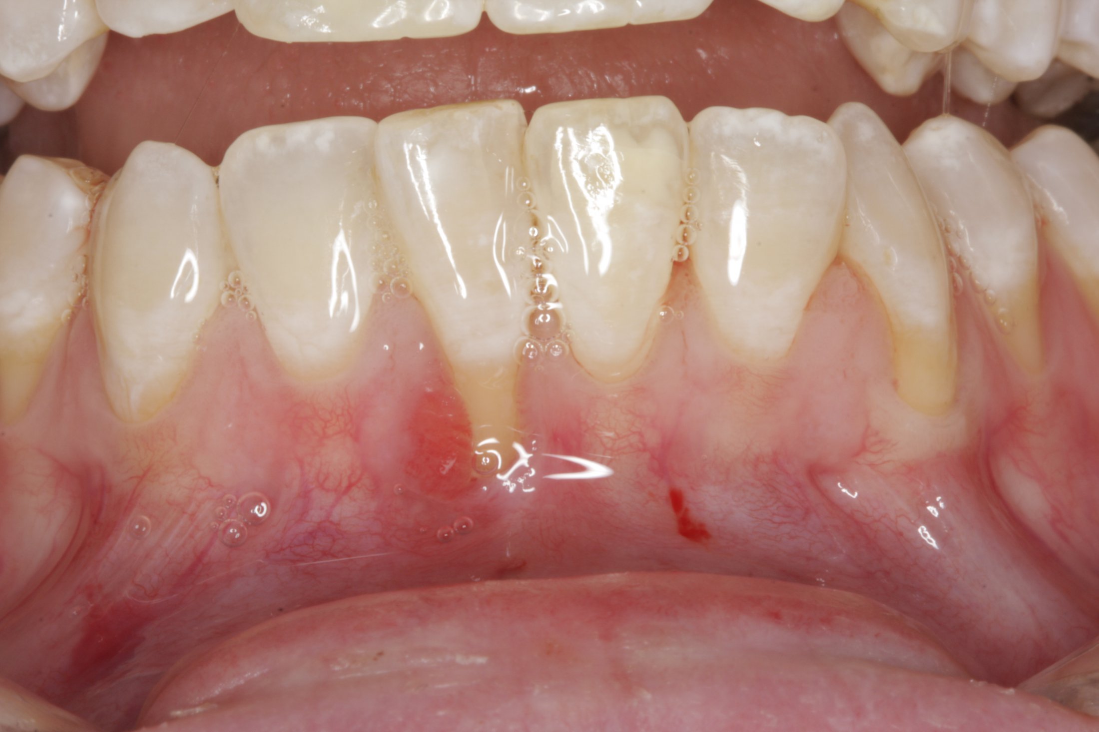 Connective Tissue Graft case study