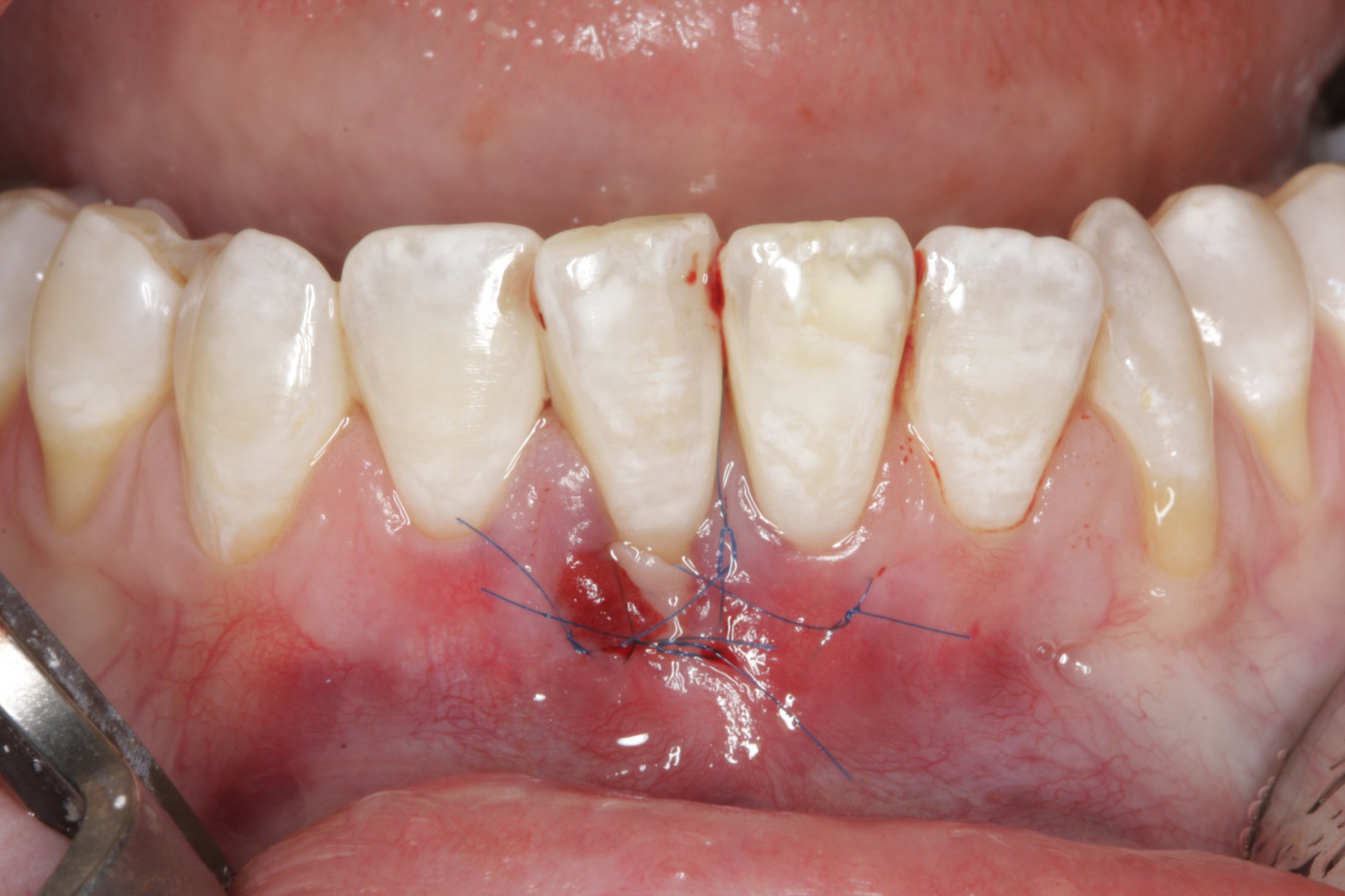 Connective Tissue Graft case study