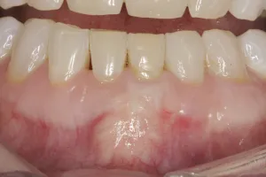 Connective Tissue Graft case study