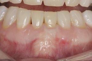Connective Tissue Graft case study