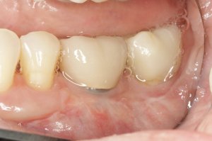 Connective Tissue Graft case study