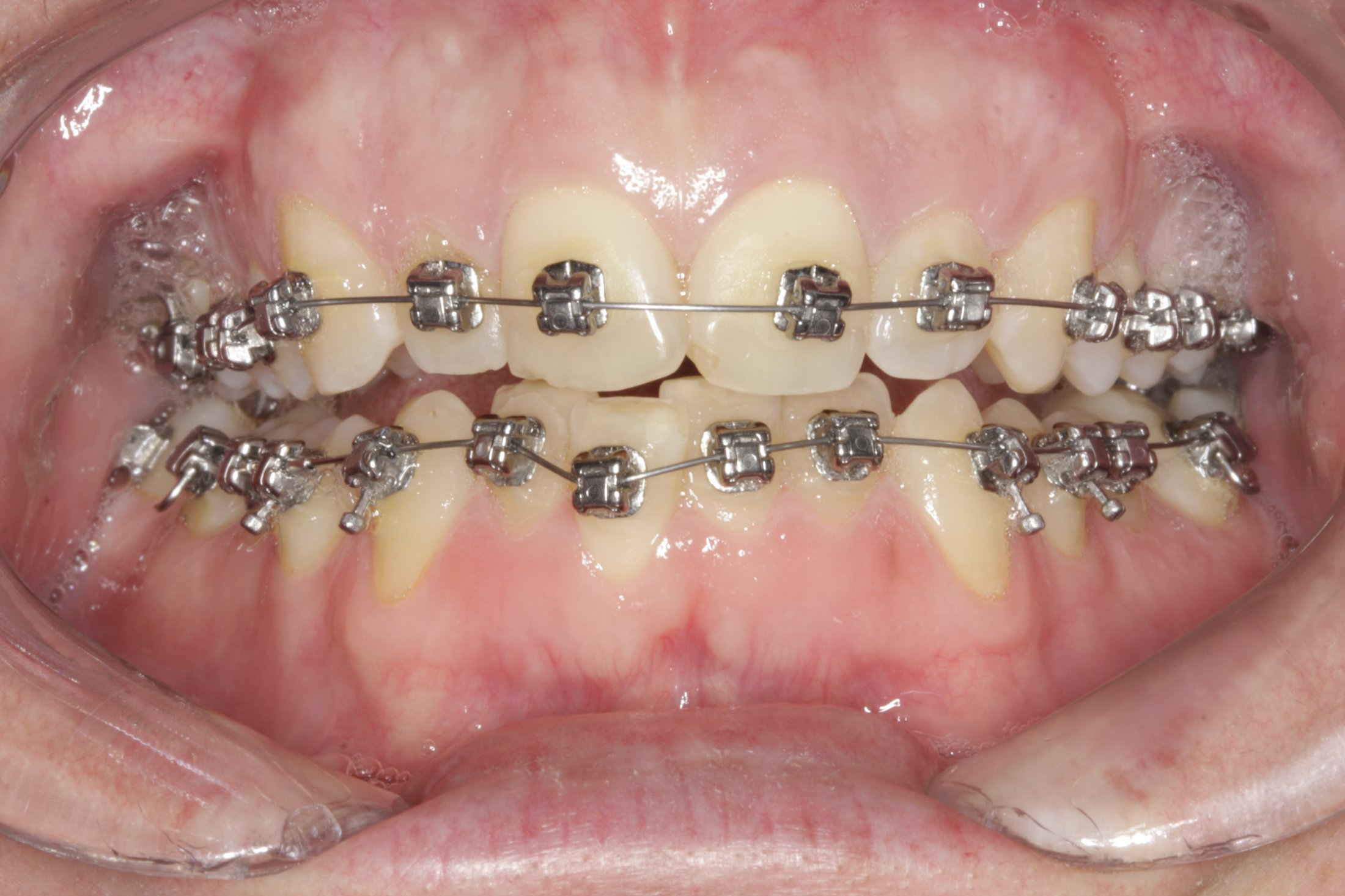 Periodontally accelerated osteogenic case study