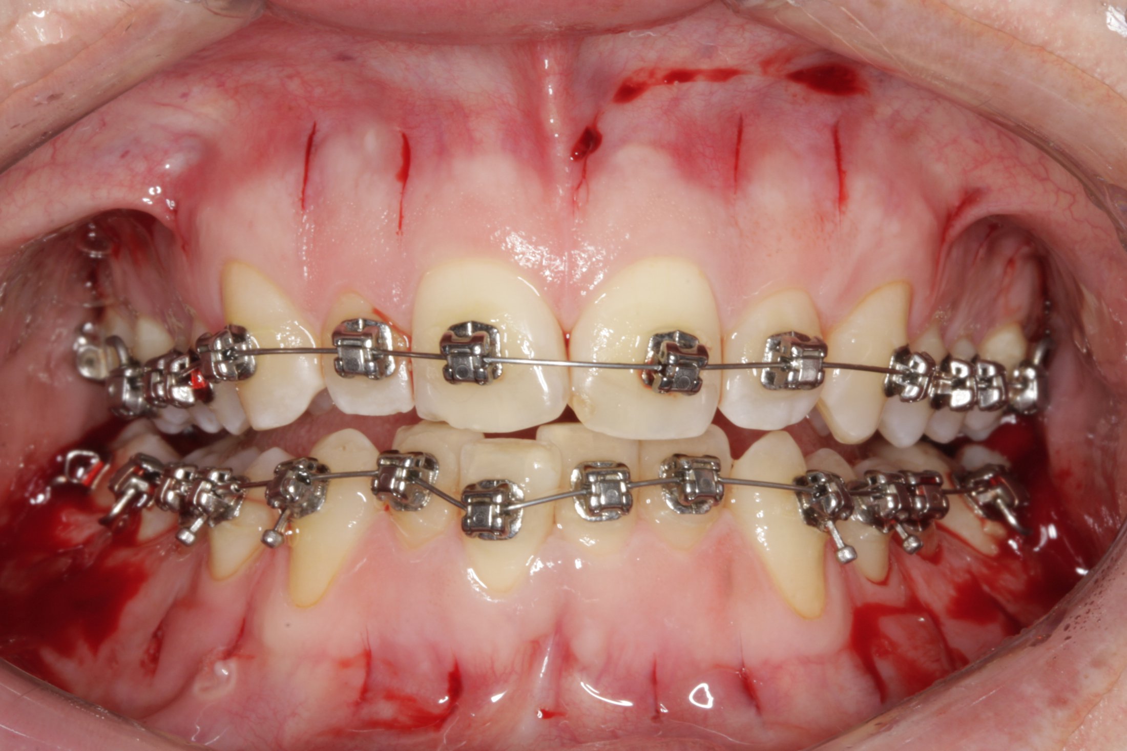 Periodontally accelerated osteogenic case study