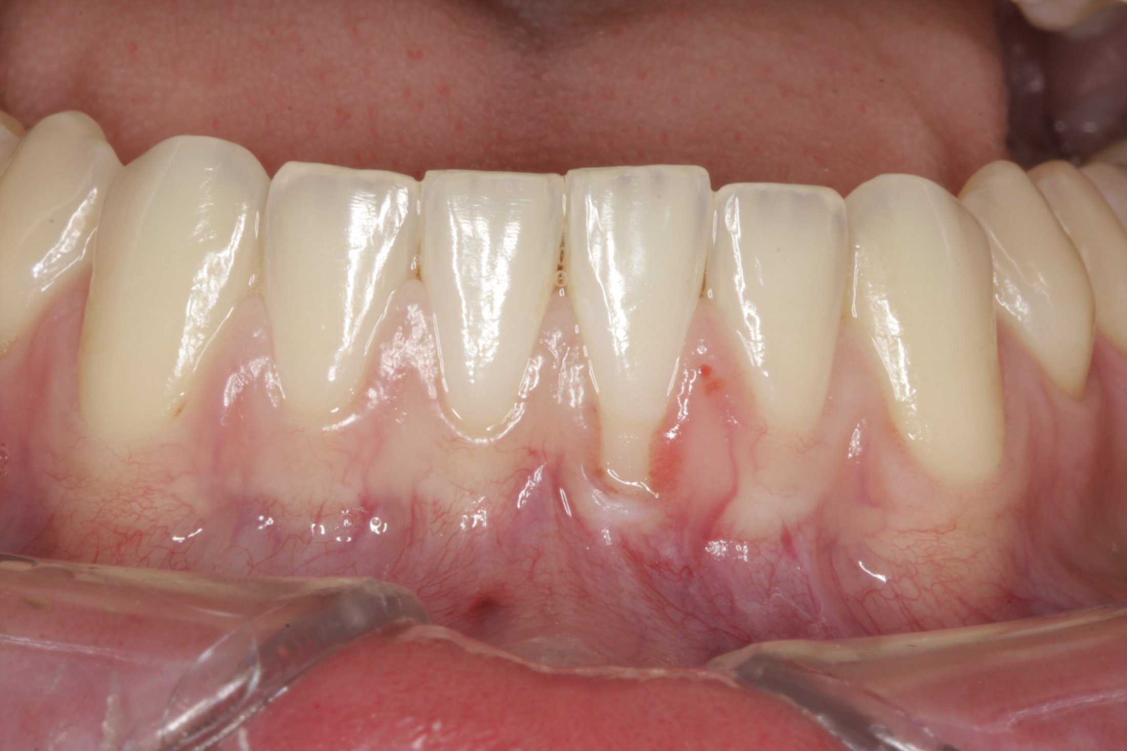 Connective Tissue Graft case study