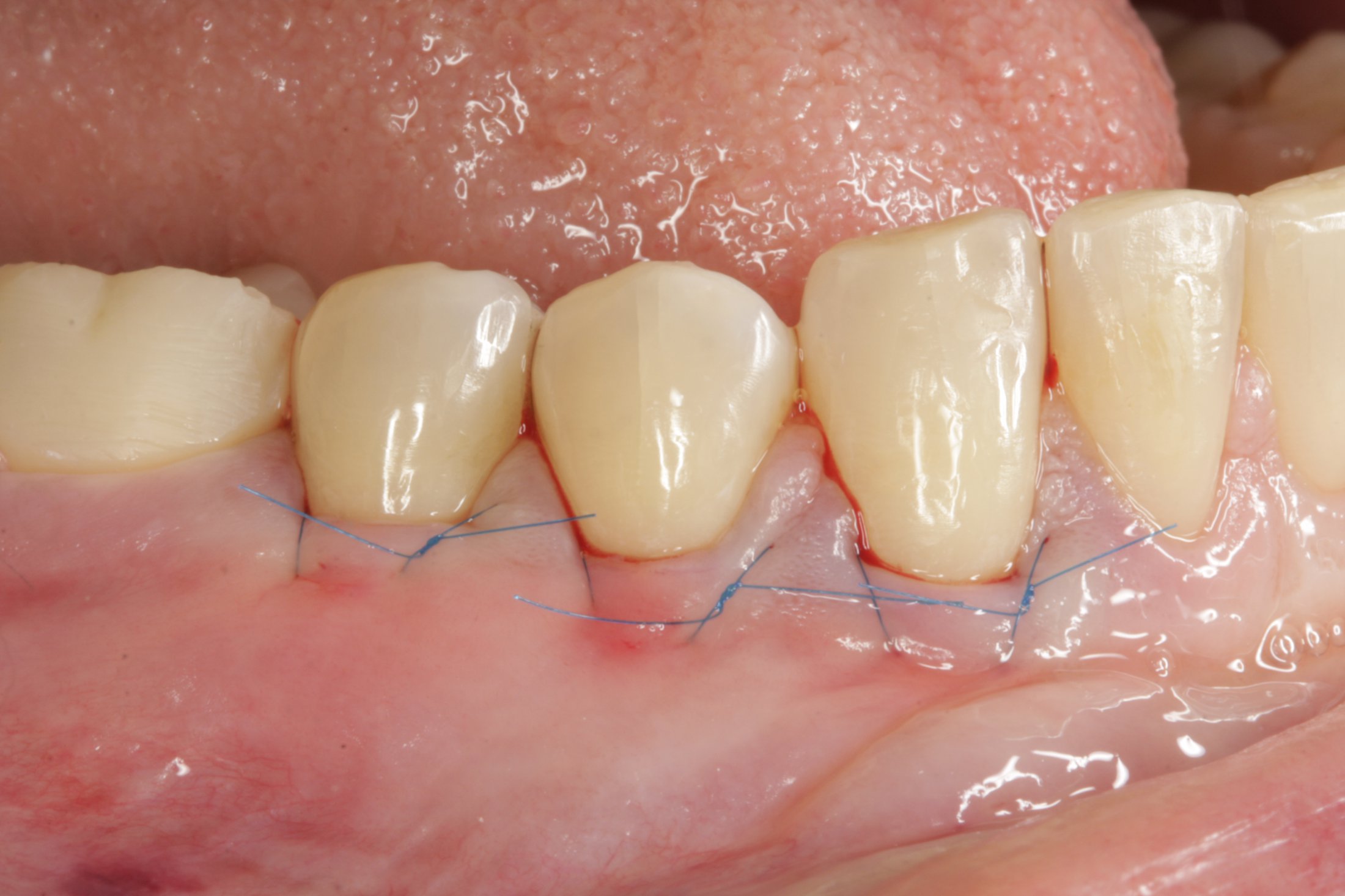 Connective Tissue Graft case study