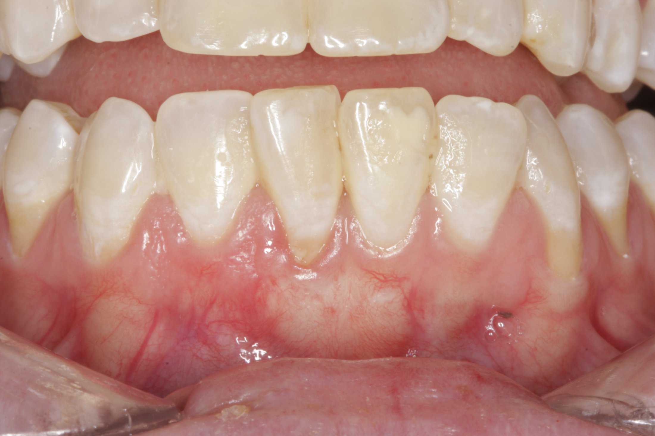 Connective Tissue Graft case study
