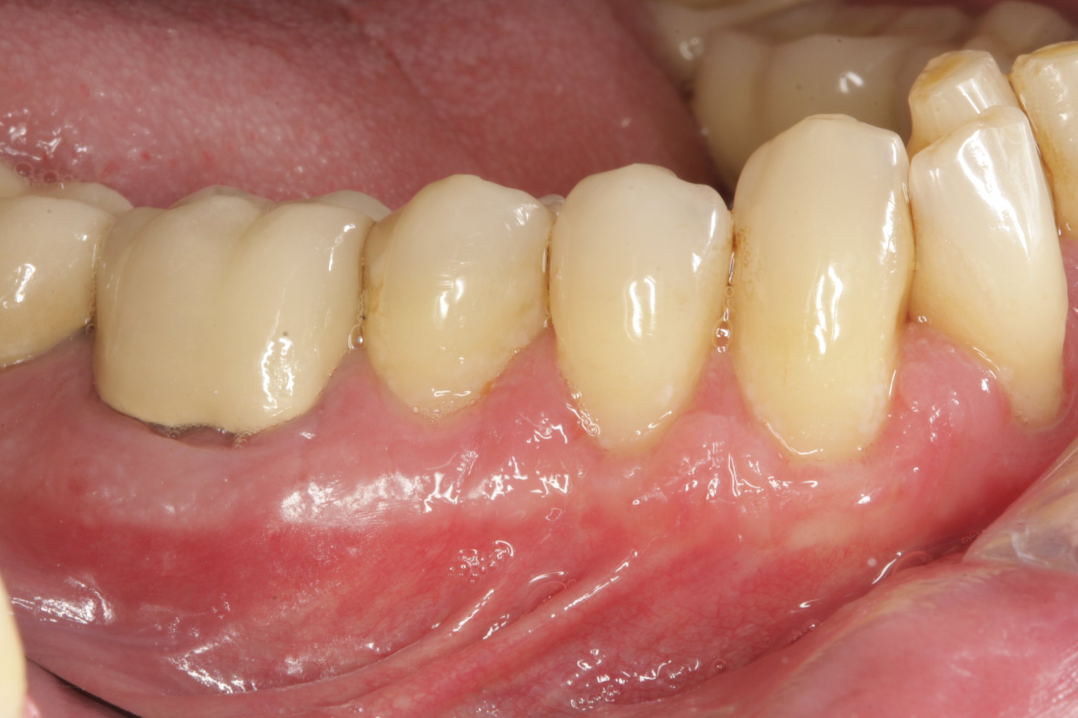 Allograft case study