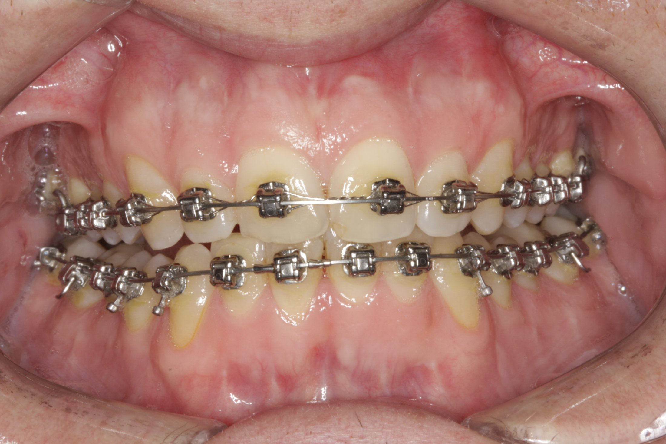 Periodontally accelerated osteogenic case study