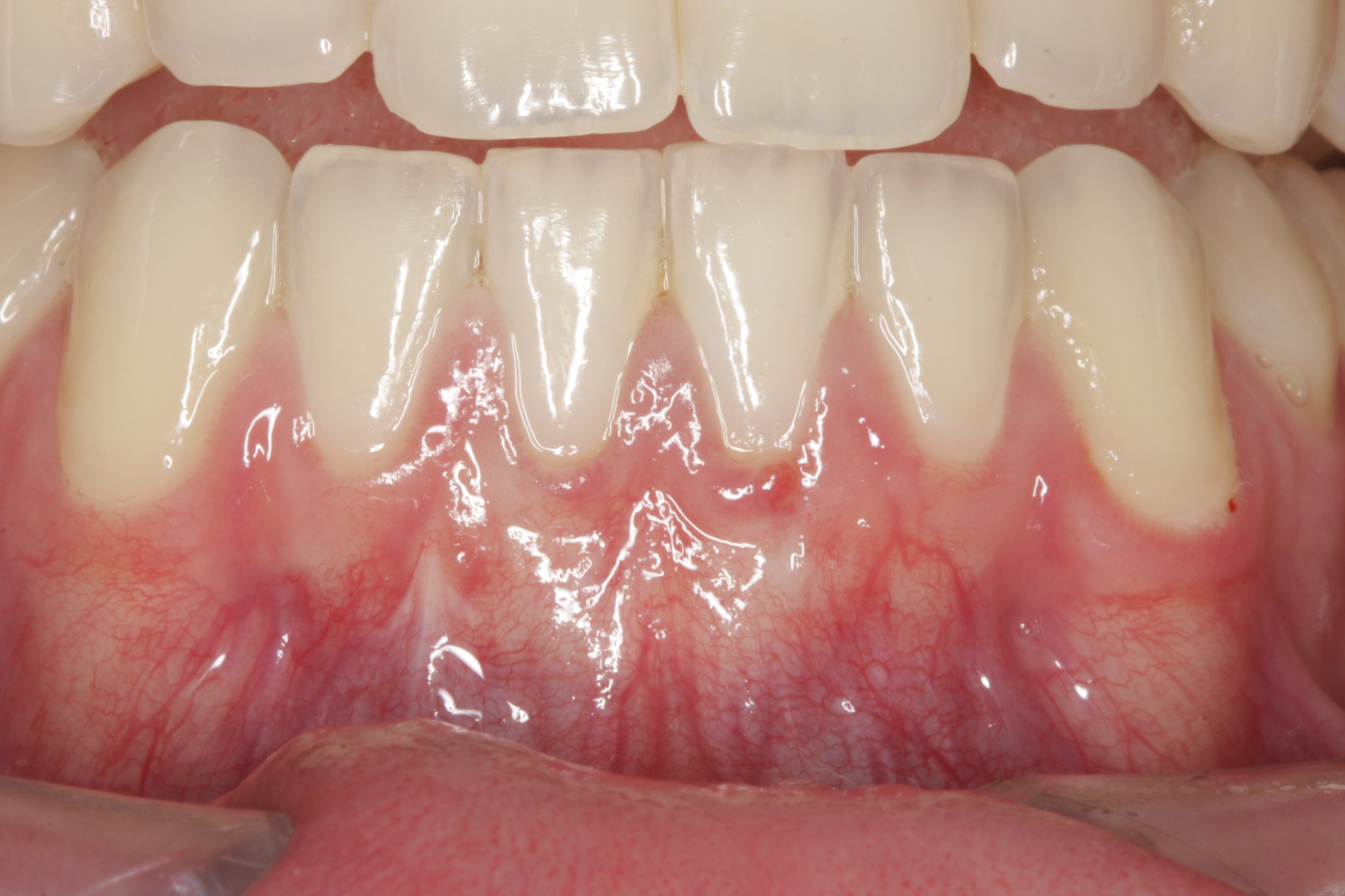 Connective Tissue Graft case study