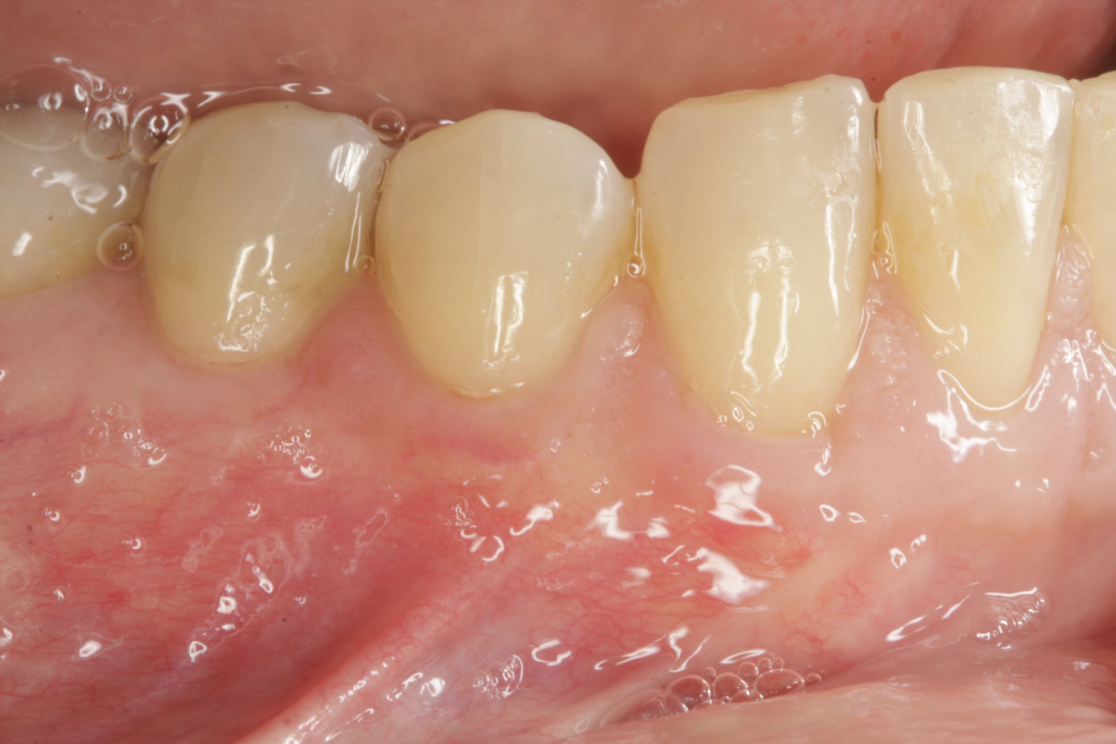Connective Tissue Graft case study