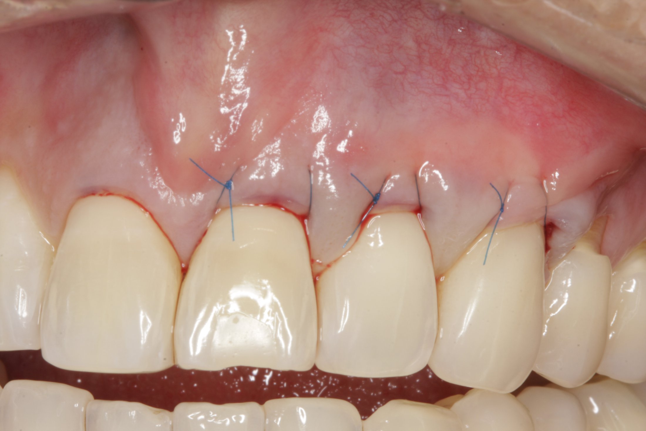 Allograft case study