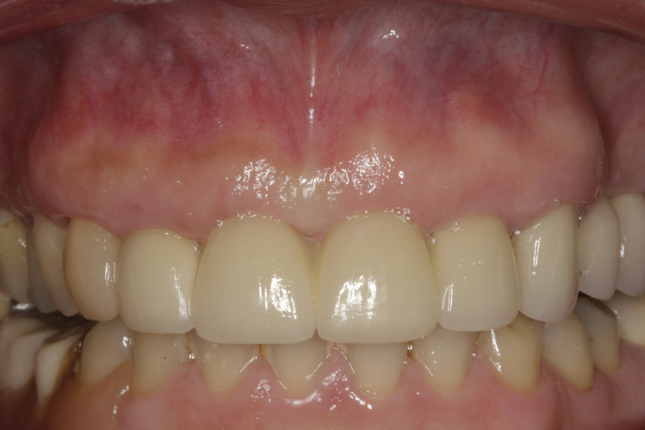 Dental Implants case study