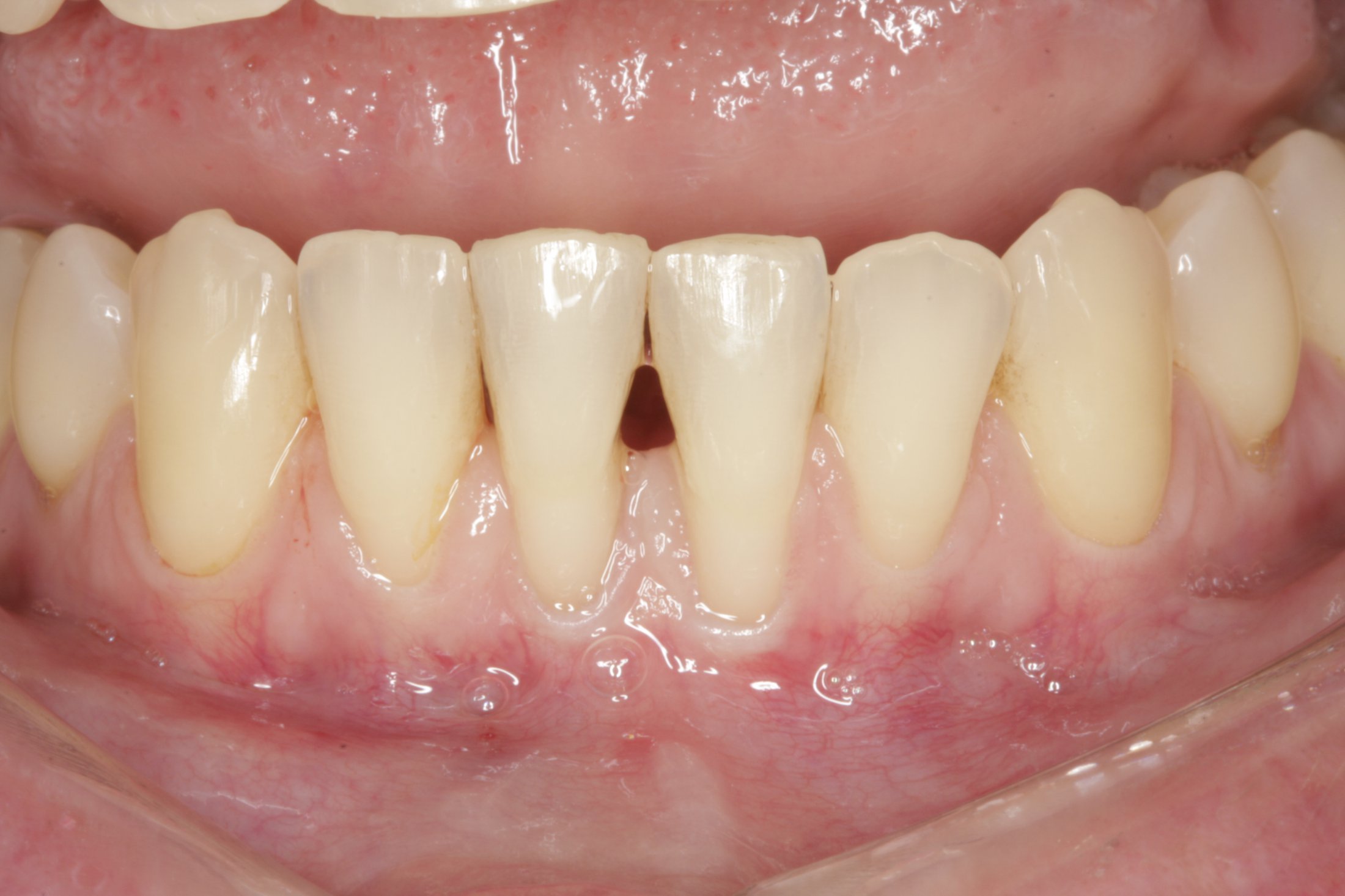 Free Gingival Graft case study