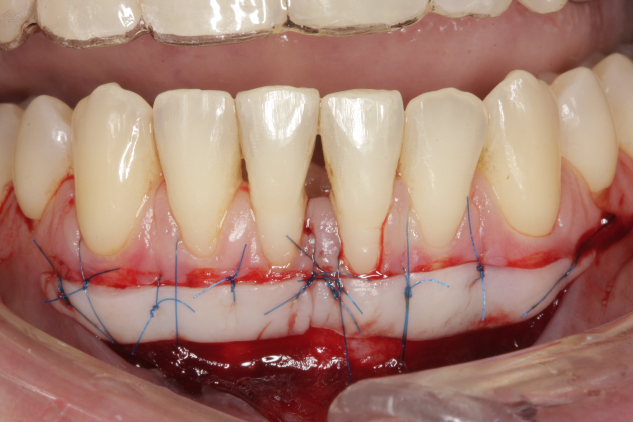 Free Gingival Graft case study