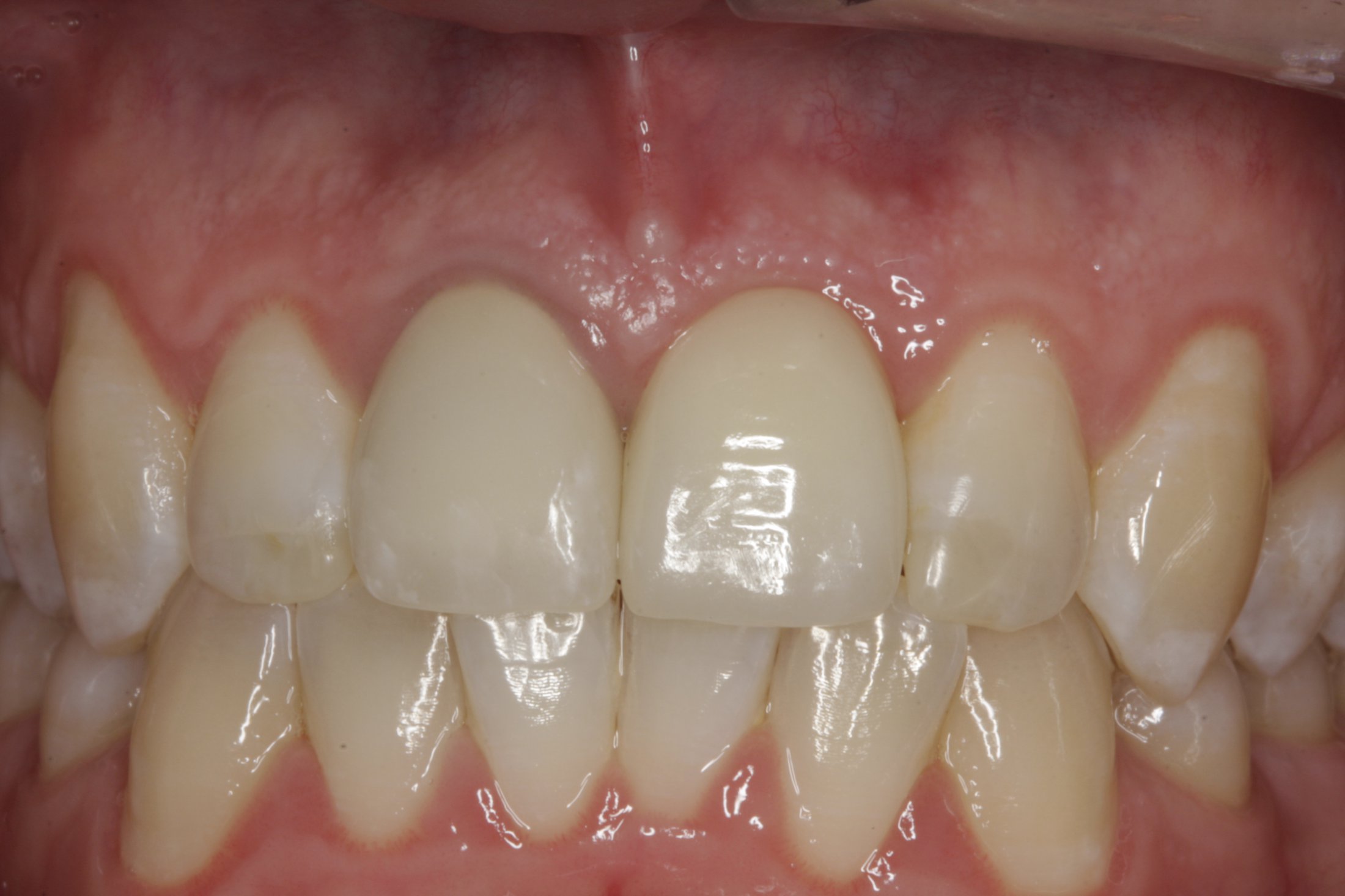 Dental Implants case study