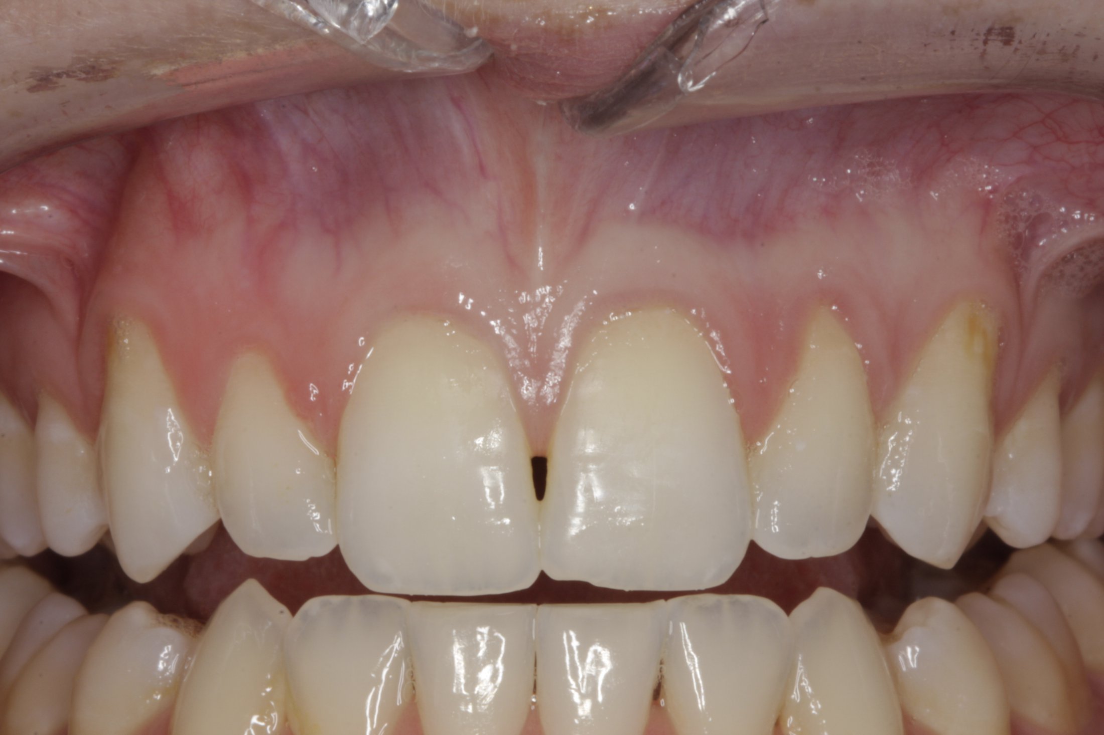 Connective Tissue Graft case study