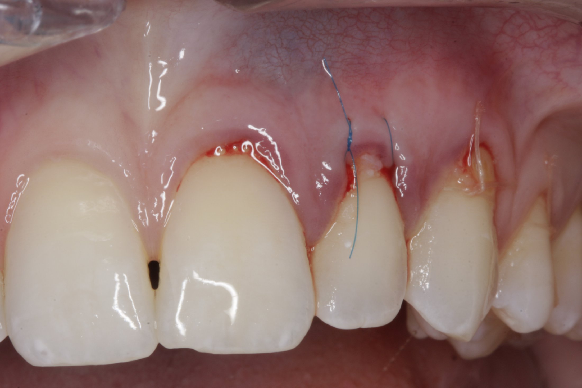 Connective Tissue Graft case study