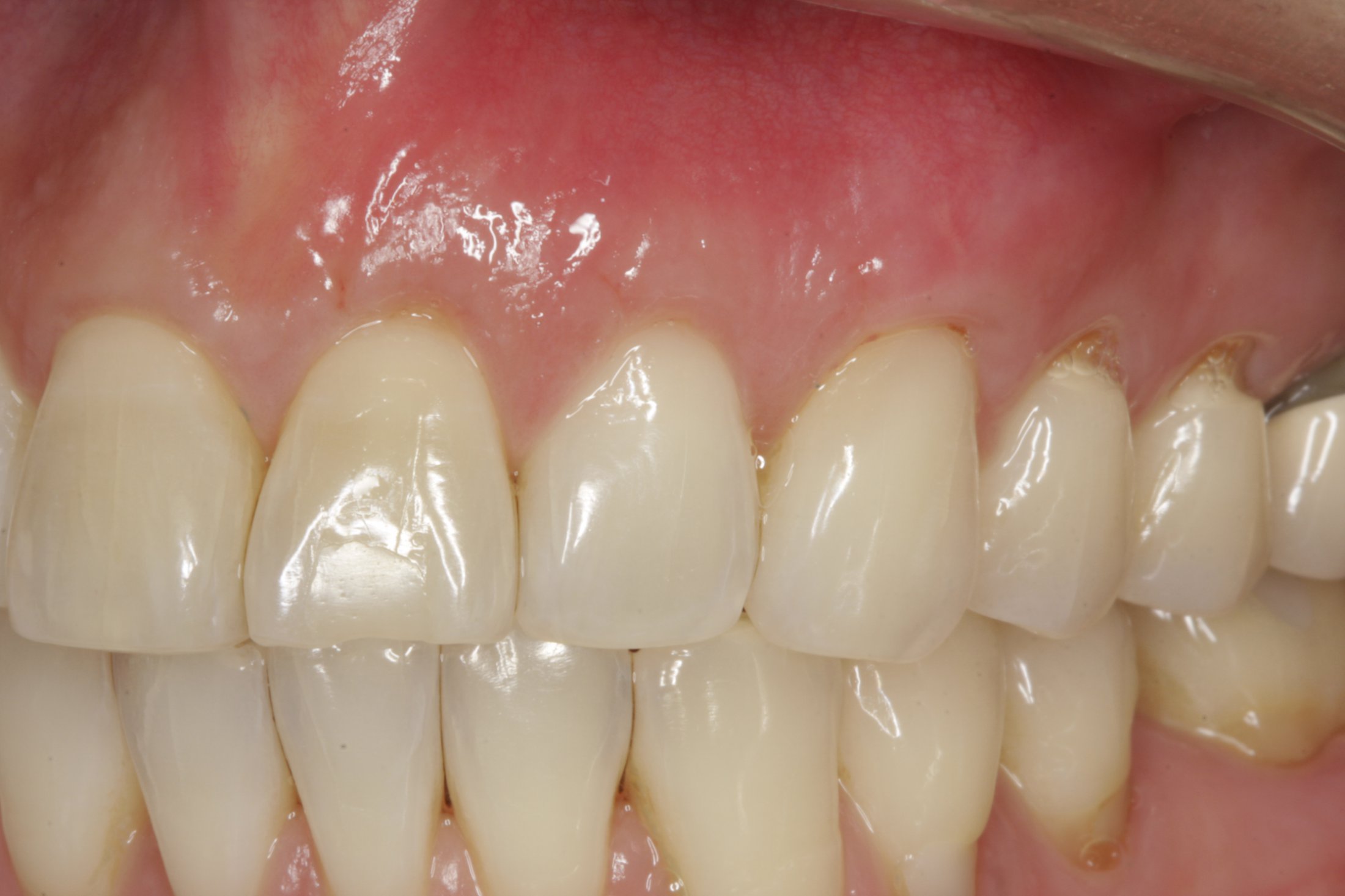 Allograft case study