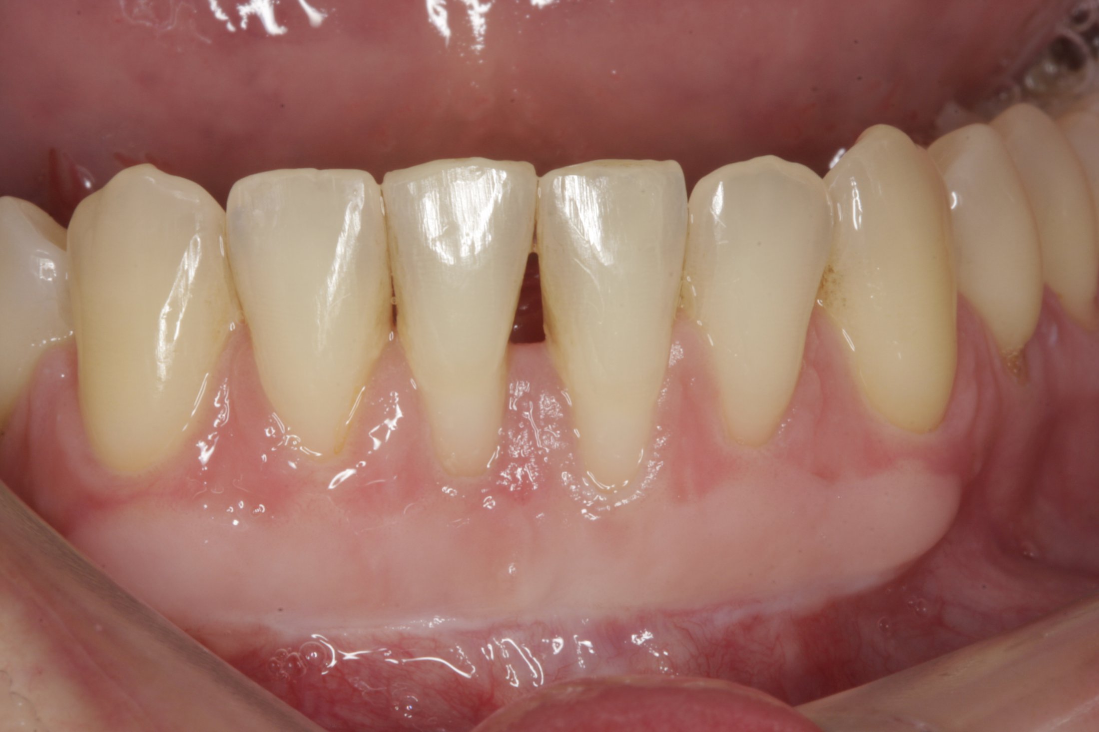 Free Gingival Graft case study