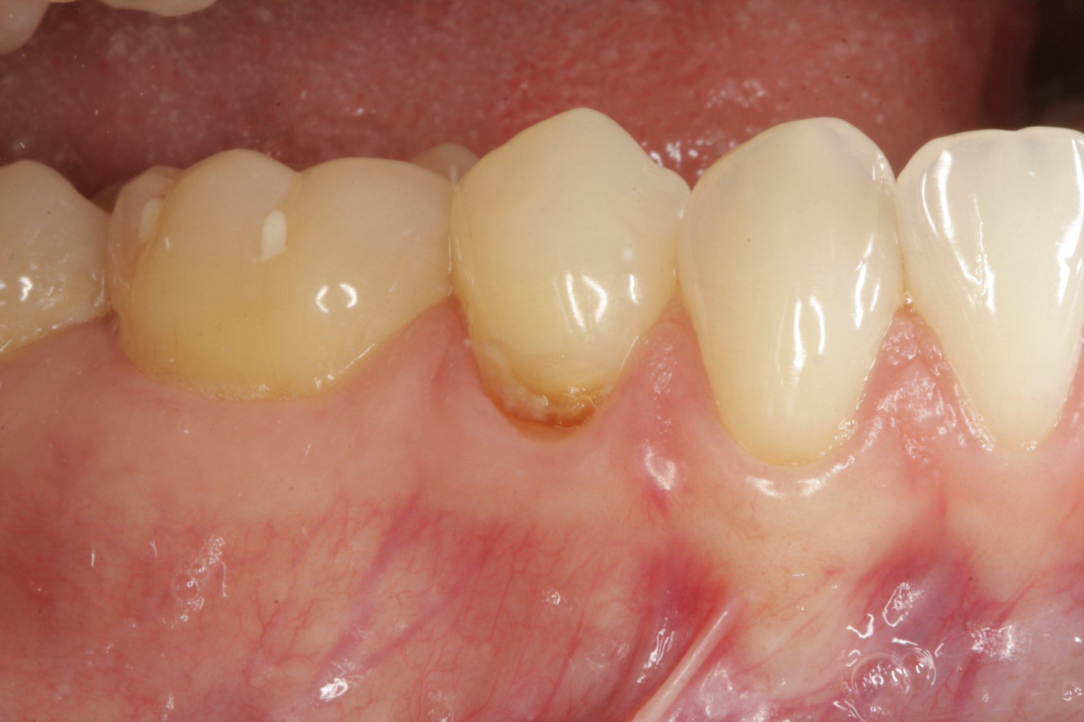 Allograft case study