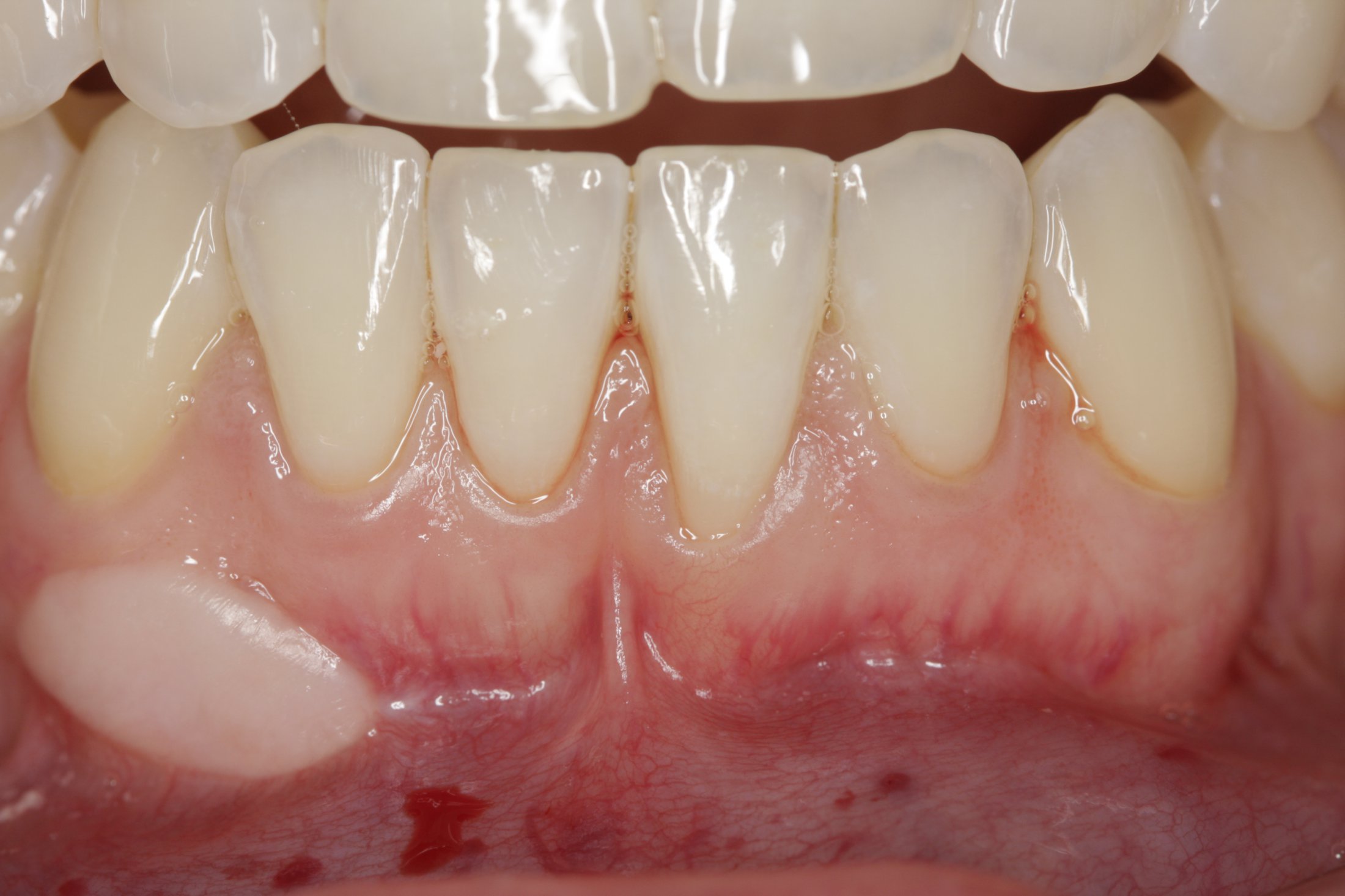 Connective Tissue Graft case study