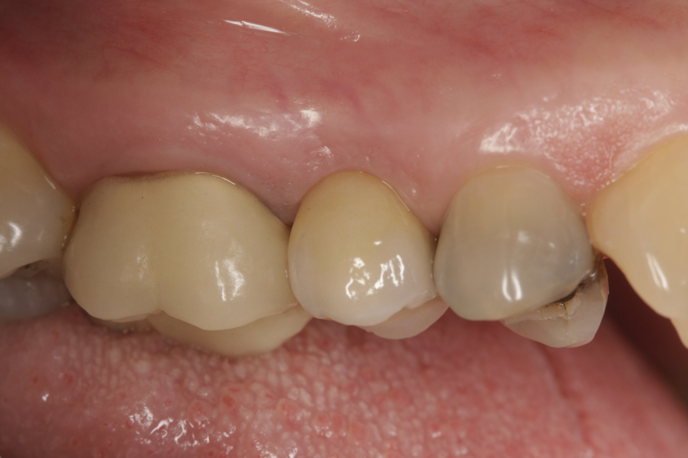 Dental Implants case study