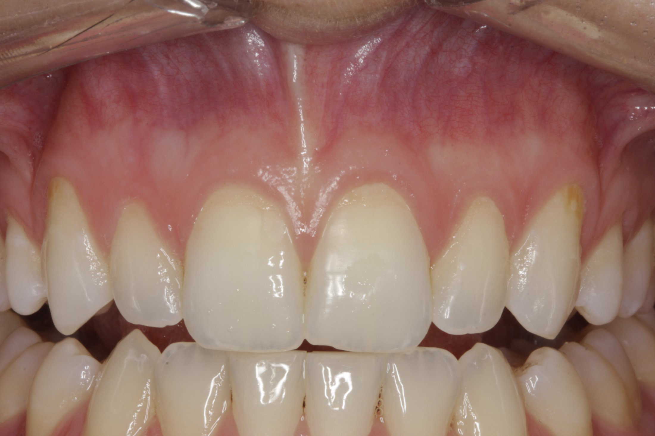 Connective Tissue Graft case study