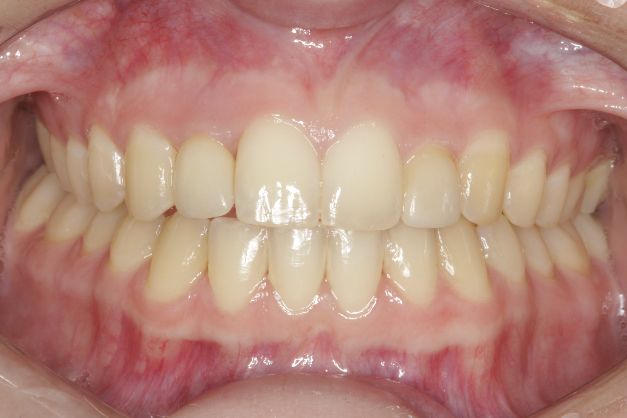 Dental Implants case study
