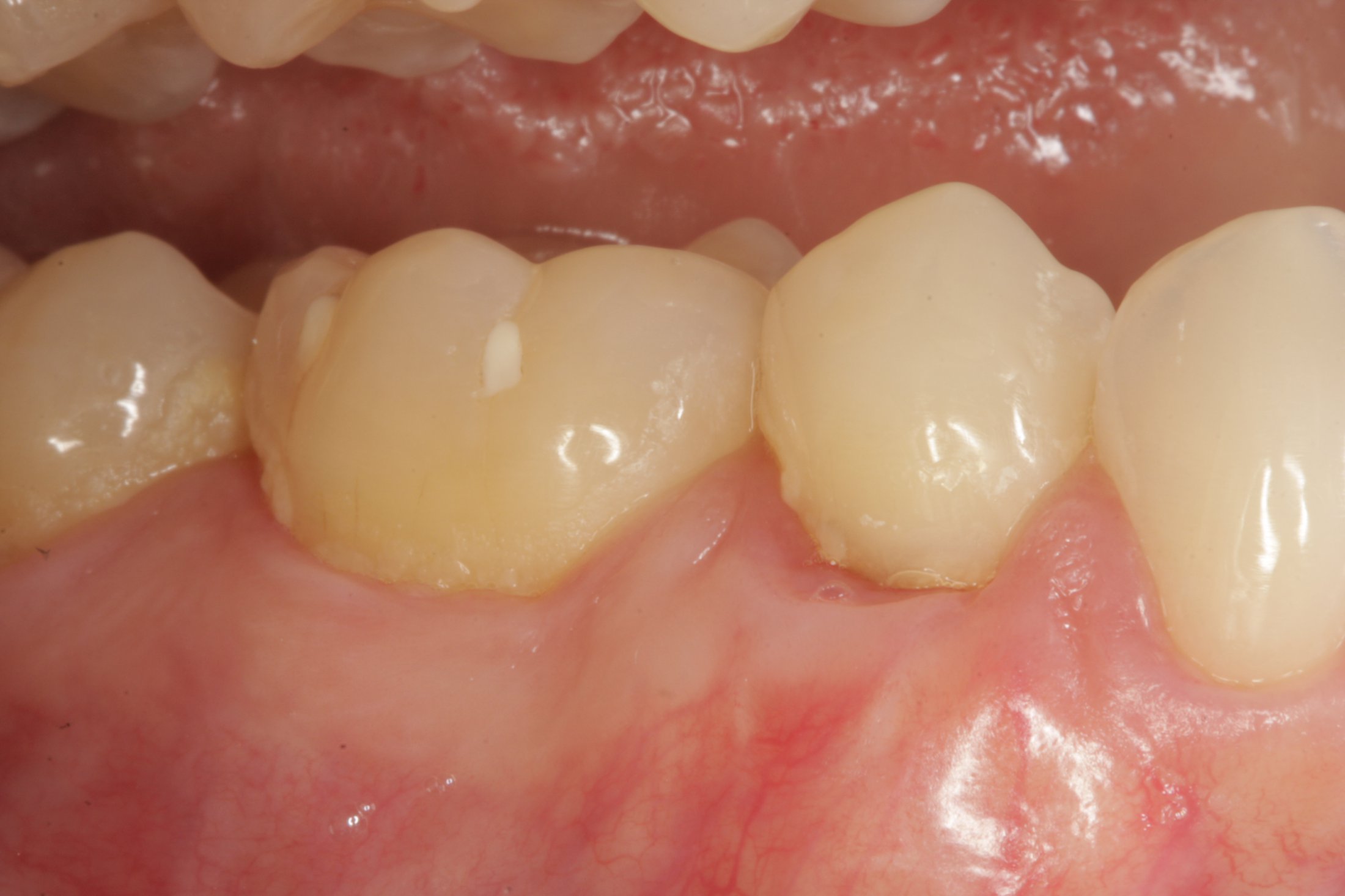 Allograft case study