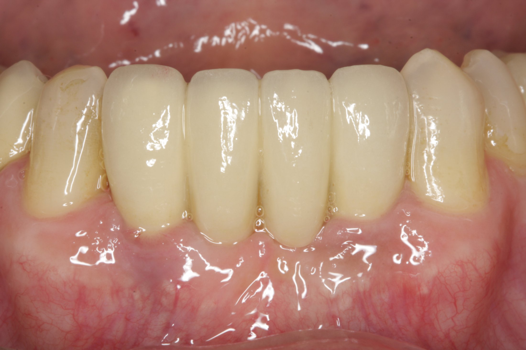 Dental Implants case study
