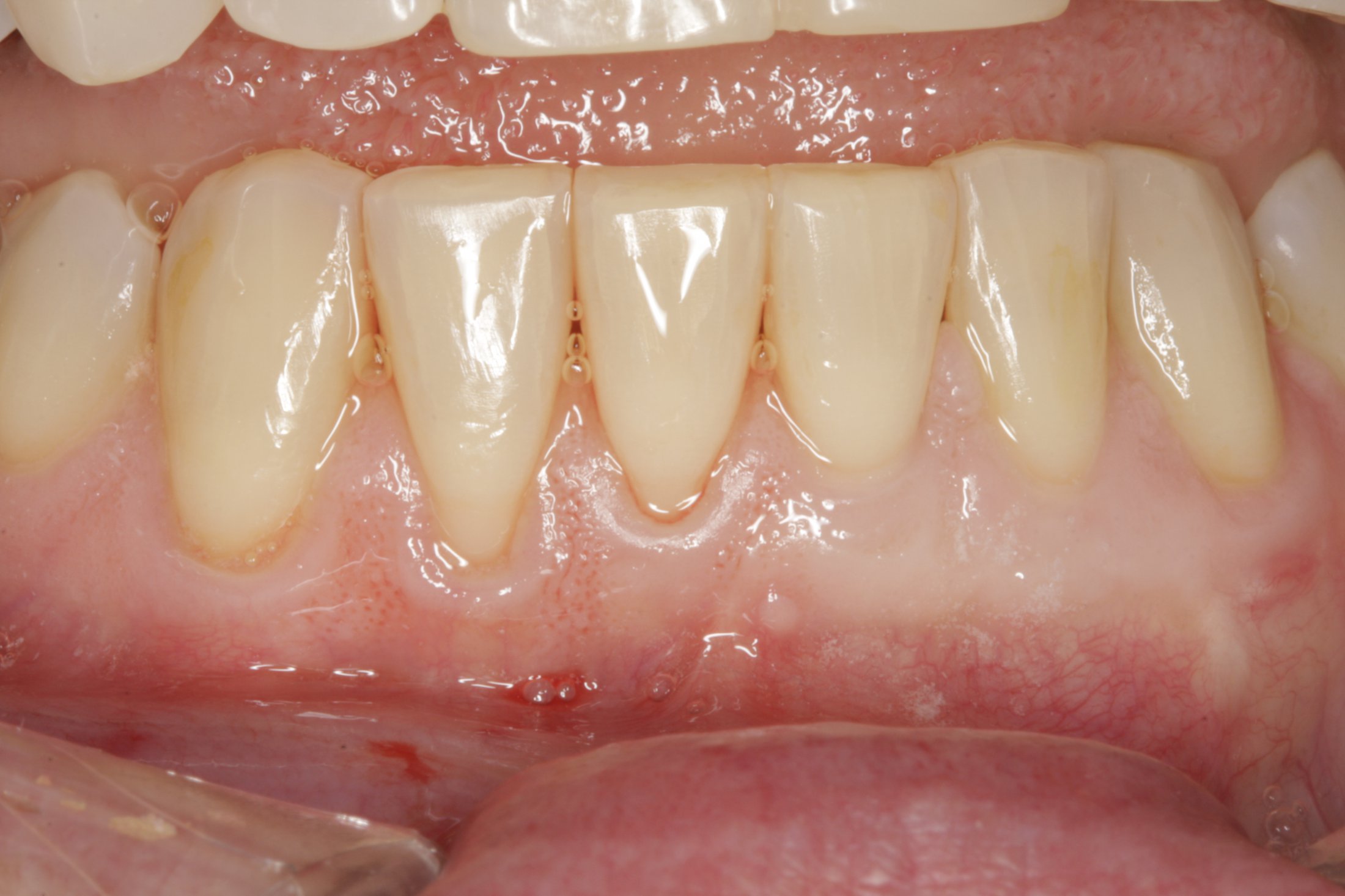 Connective Tissue Graft case study
