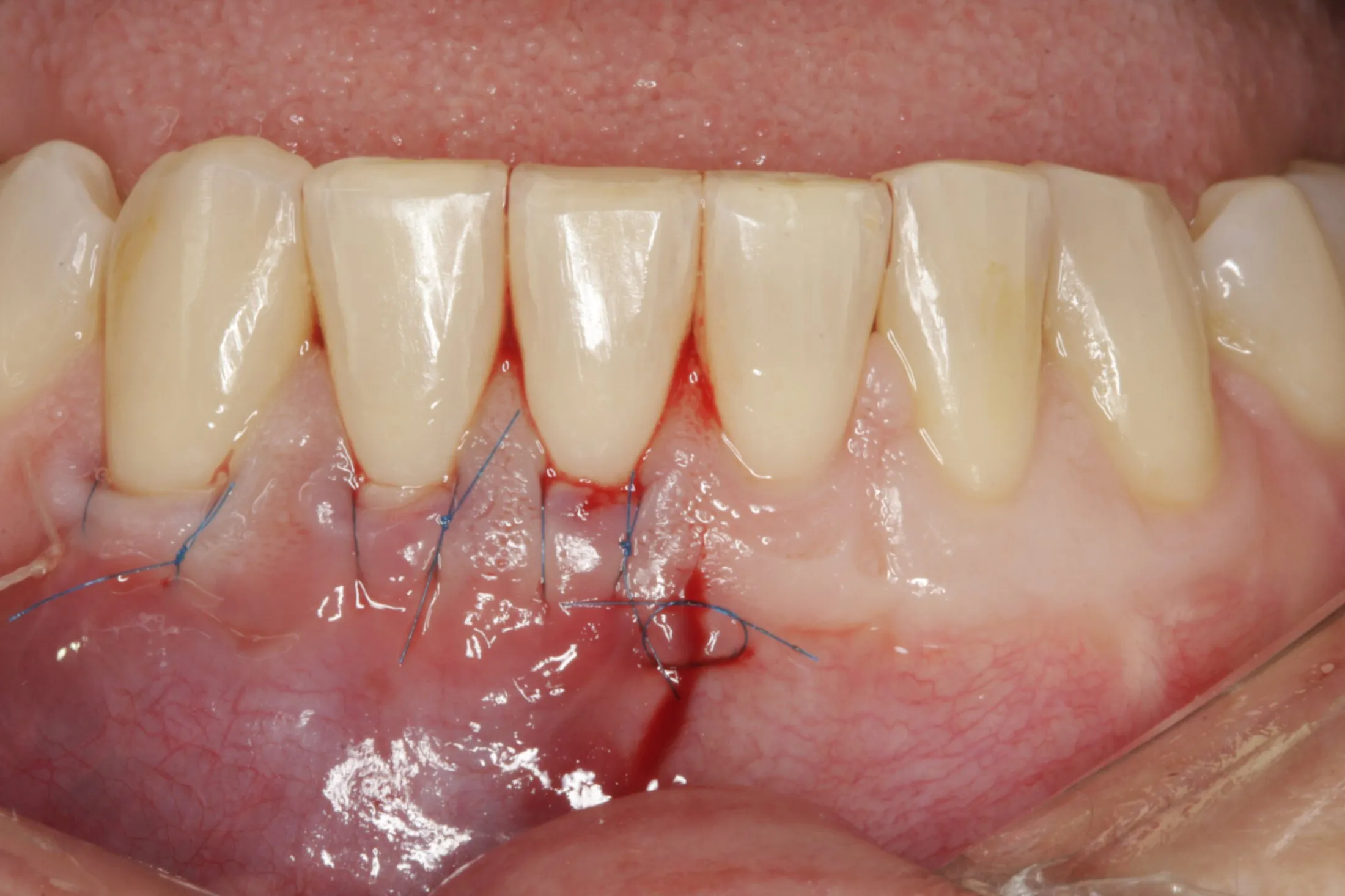 Connective Tissue Graft case study