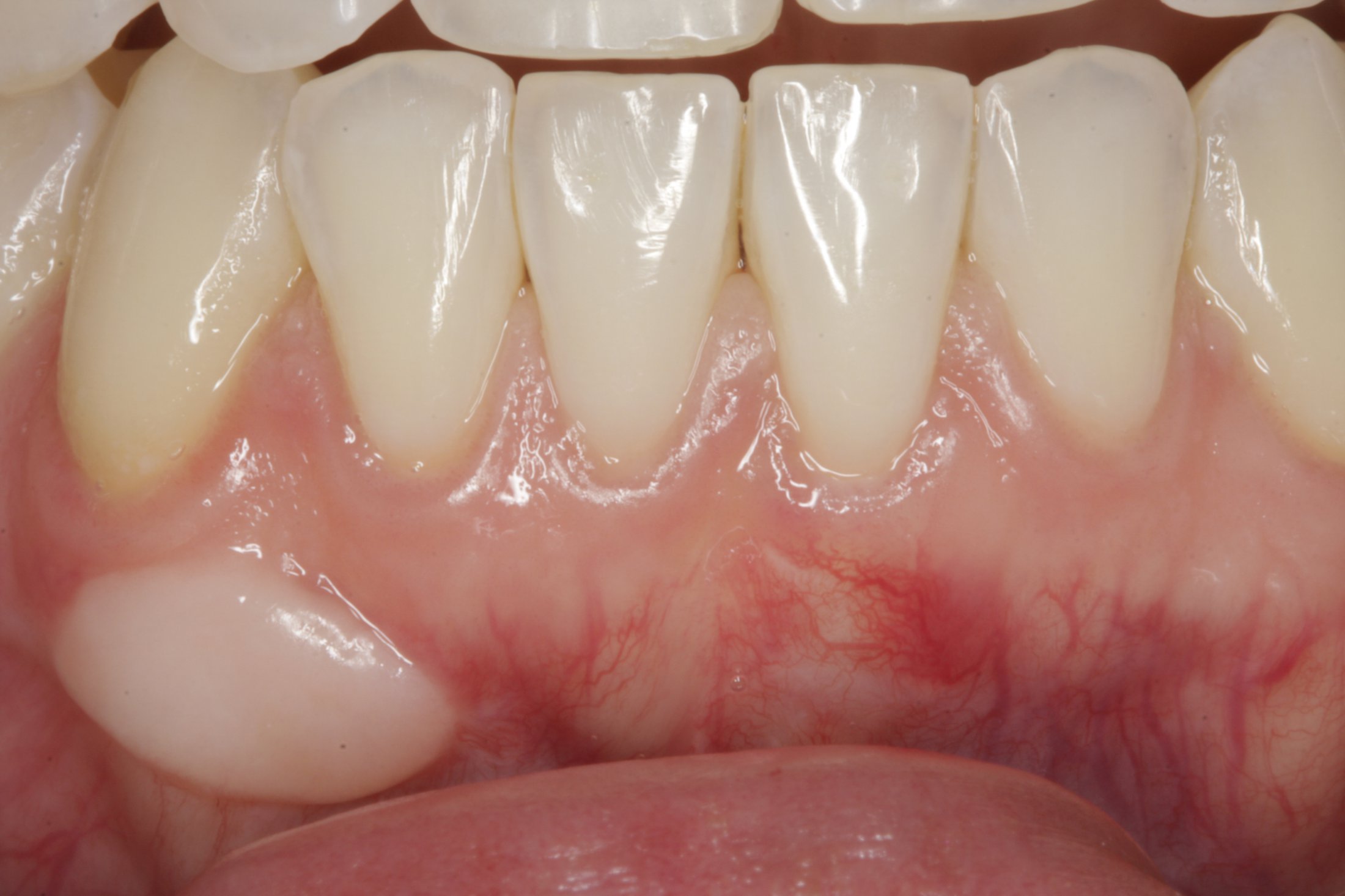 Connective Tissue Graft case study