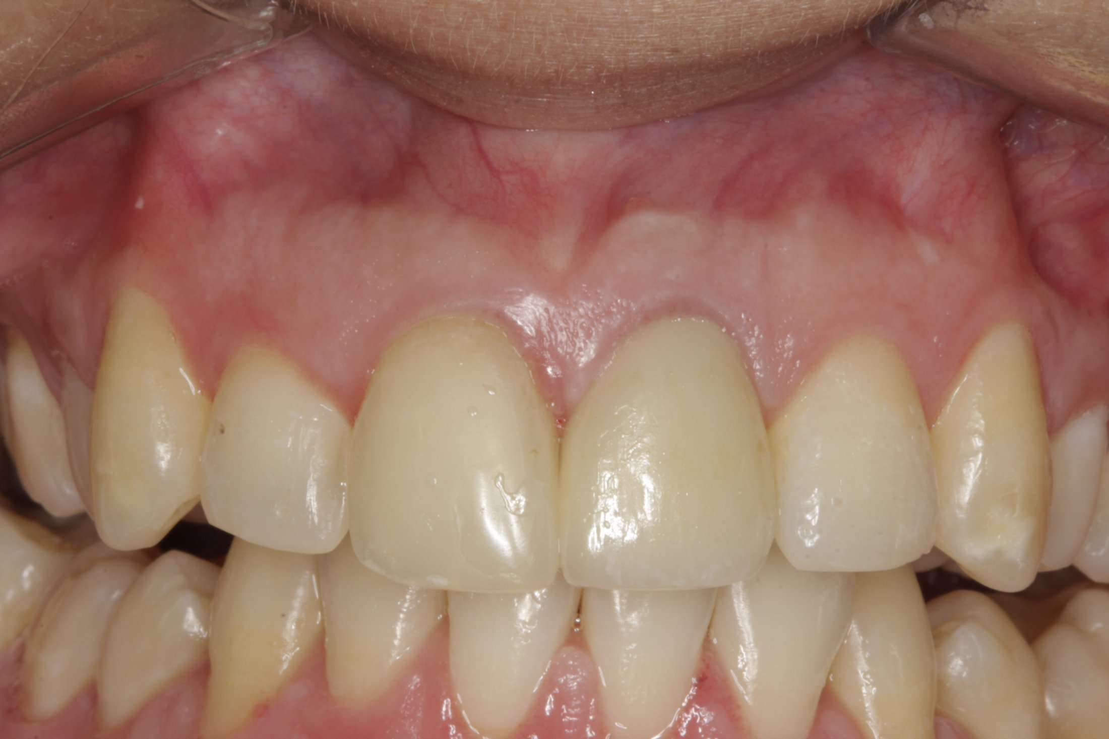 Dental Implants case study
