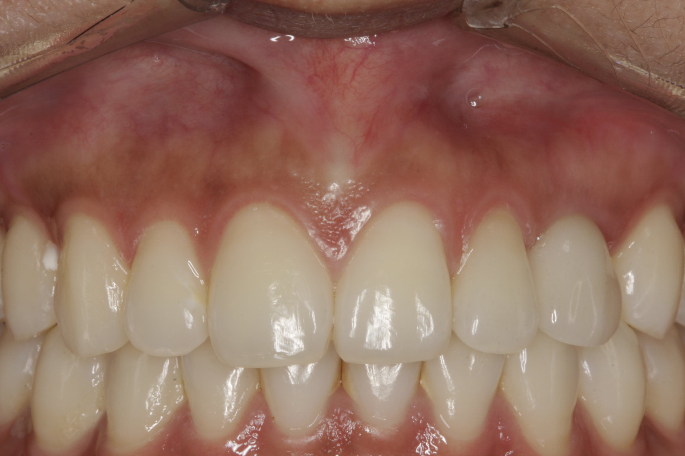 Dental Implants case study