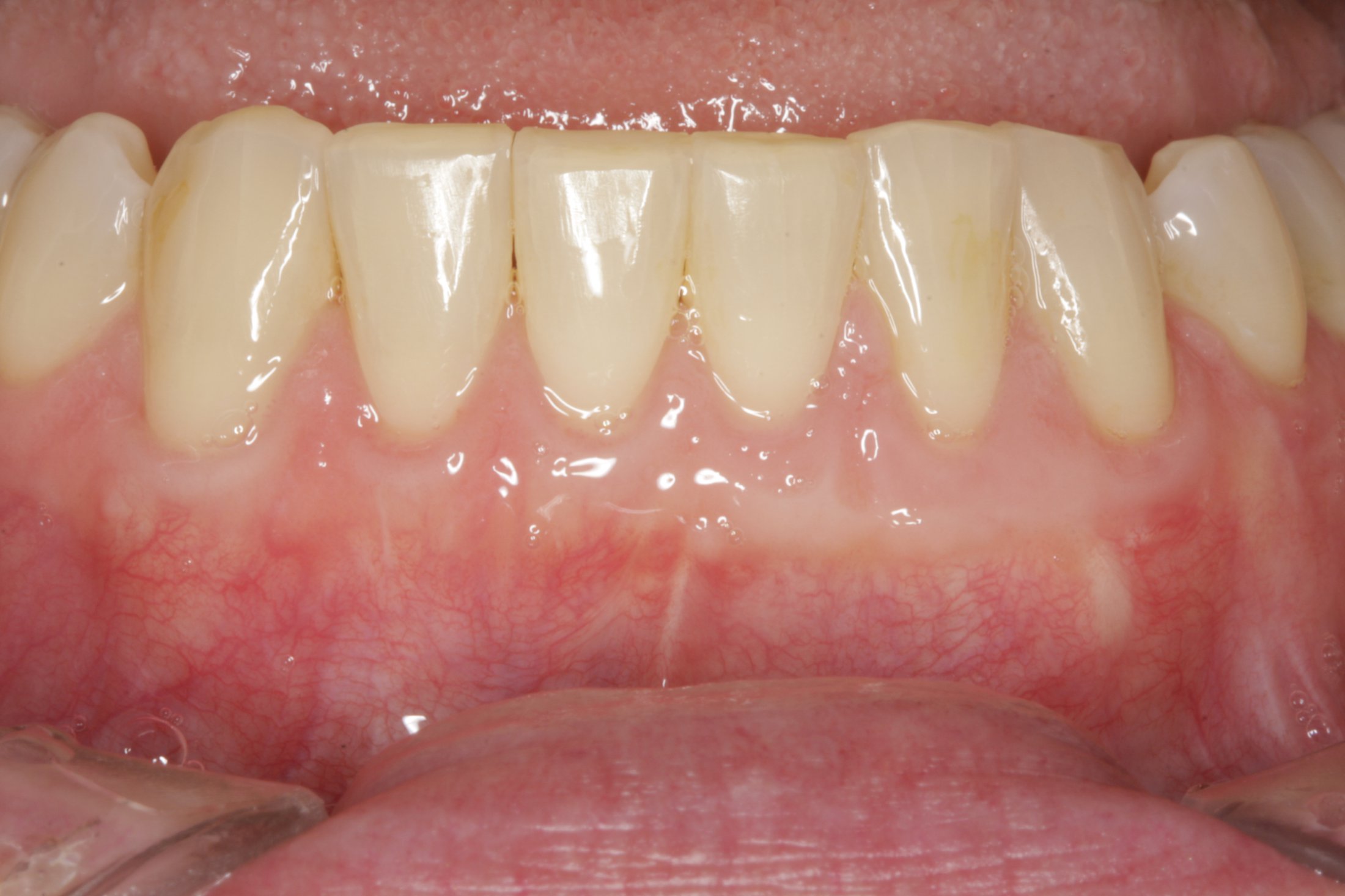 Connective Tissue Graft case study
