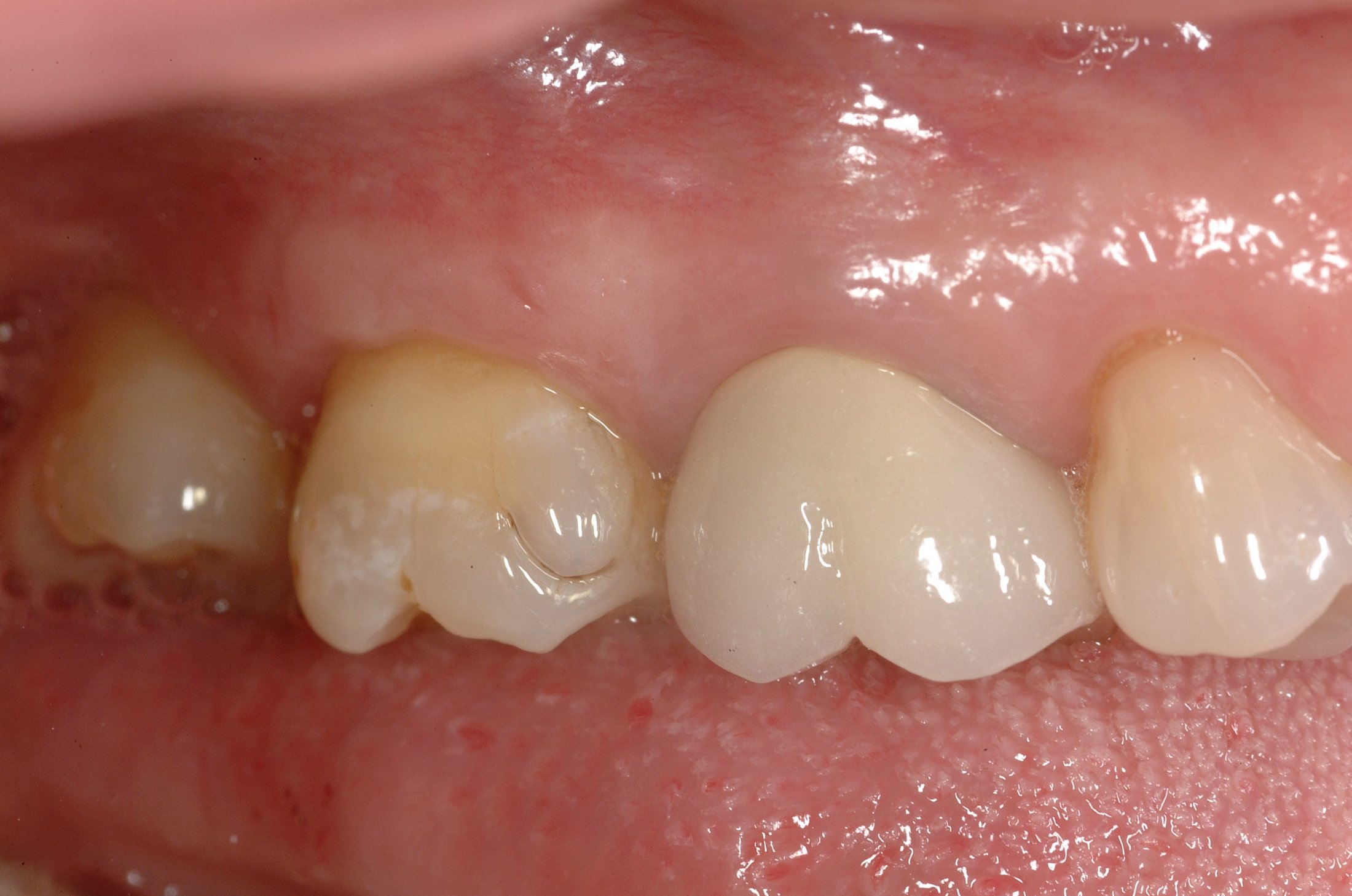 Allograft case study