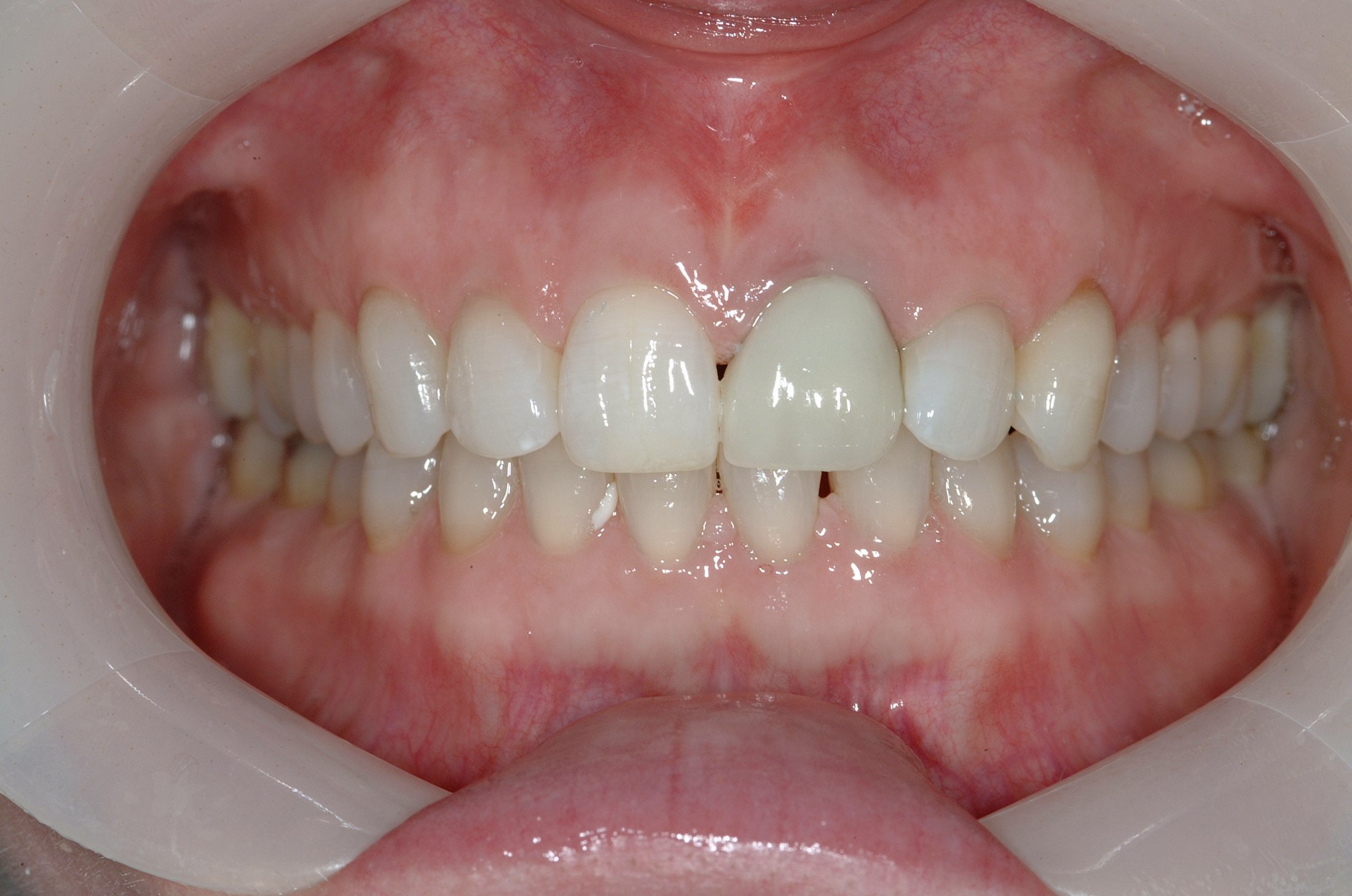 Dental Implants case study