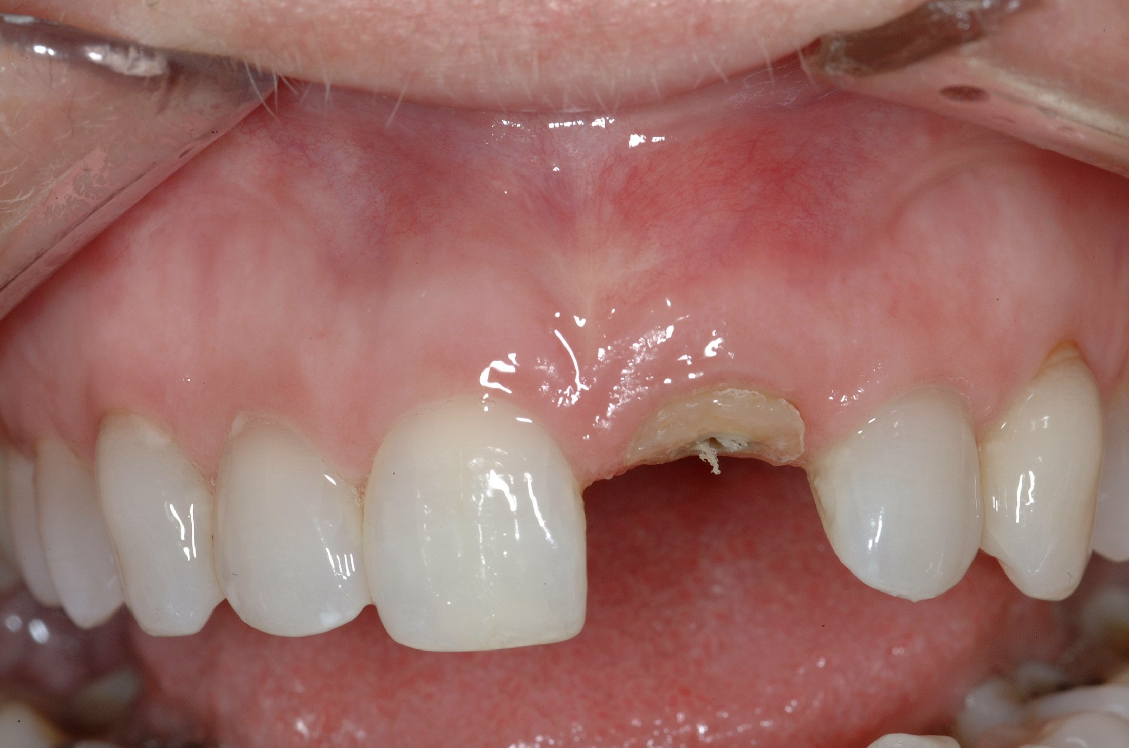 Dental Implants case study