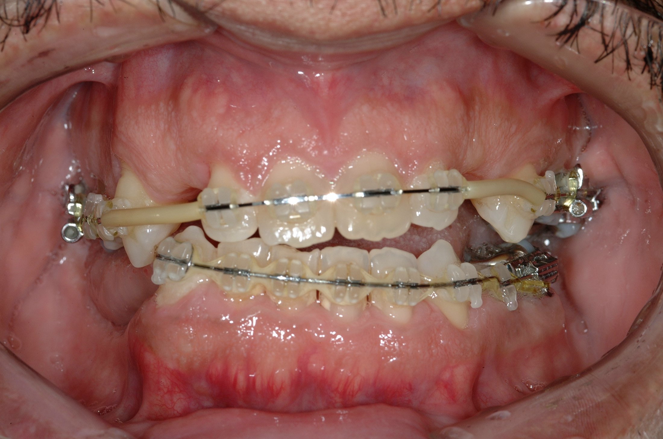 Dental Implants case study