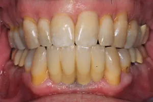 Dental Implants case study