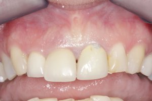 Dental Implants case study