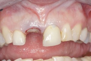 Dental Implants case study